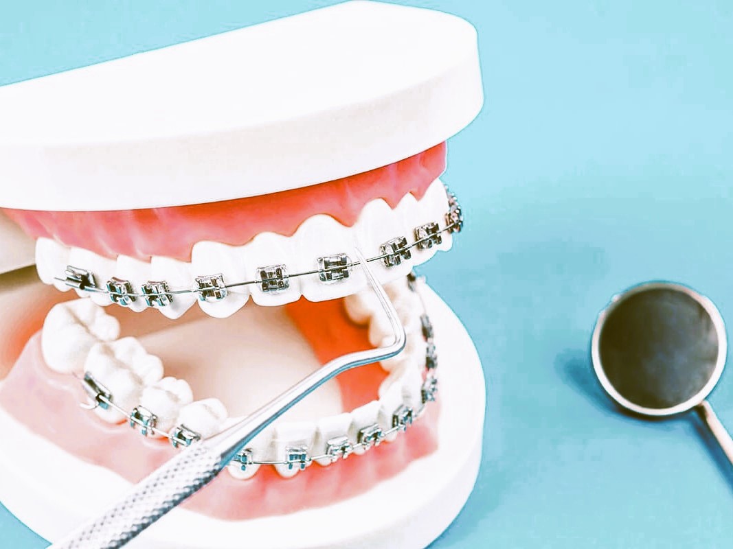 56. Brace Face KDRT 95.7FM Davis