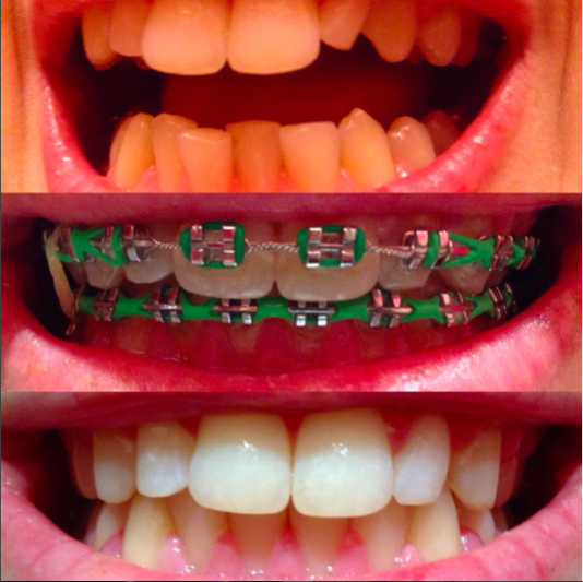 Braces